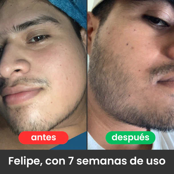 Bálsamo para Crecimiento de Barba Ultra Potente con Minoxidil 20% |