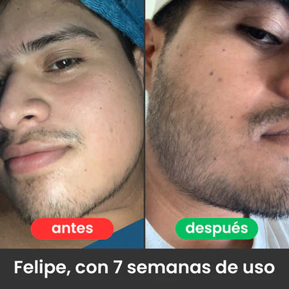 Bálsamo para Crecimiento de Barba Ultra Potente con Minoxidil 20% |